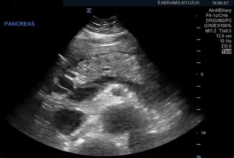 Pancreas Ultrasound