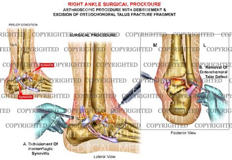 Right ankle arthroscopic debridement — Medical Art Works