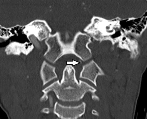 Atlanto Occipital Joint Xray