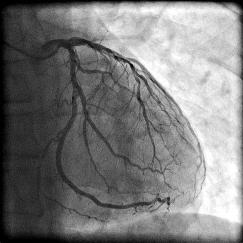 Coronary Angiogram - Dr Diana Holdright