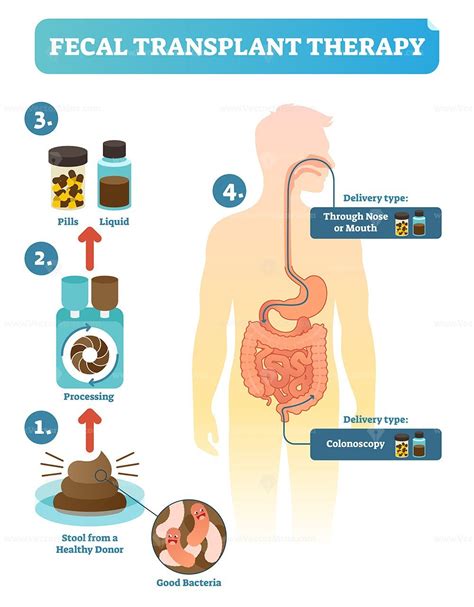 Fecal transplant therapy, procedure steps diagram, vector illustration ...