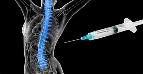 Neurolytic Lumbar Facet Block - Atlanta, GA - Spine Surgery