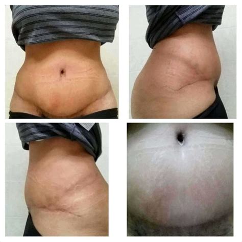 Swelling after tummy tuck surgery gallery » Tummy Tuck: Prices, Photos ...