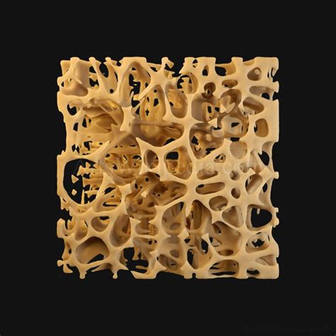 3D Trabeculae of Spongy Bone Osteoporosis Histology