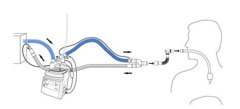 Breathing circuits for manual and mechanical ventilation | Deranged ...