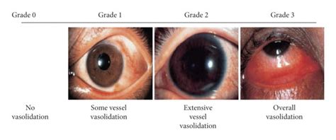 Standard photographs of the severity of conjunctival hyperaemia by ...