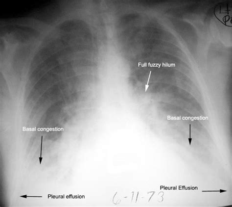 Cardiomegaly Basal congestion: This is gravity dependent accumulation ...