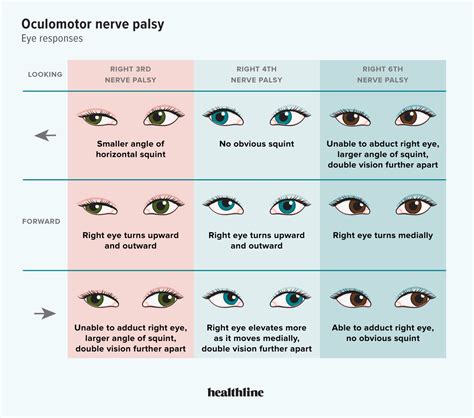 Oculomotor Nerve Palsy