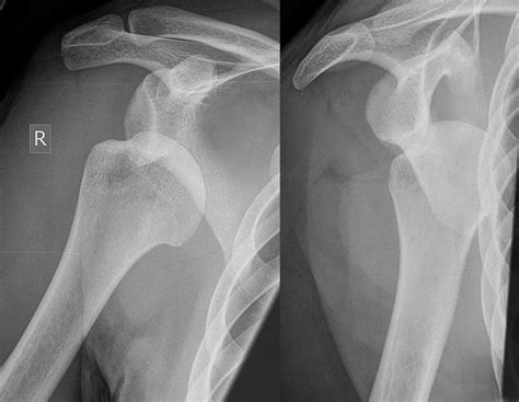 Shoulder Dislocation – Core EM