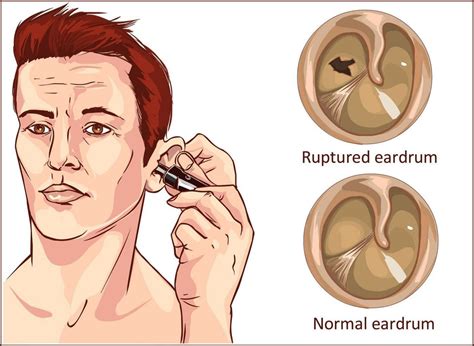 Tympanic Membrane Perforation: Symptoms, Causes, and Treatment Options