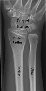 Radius Fracture