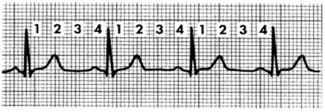 The normal ECG tracing | Download Scientific Diagram