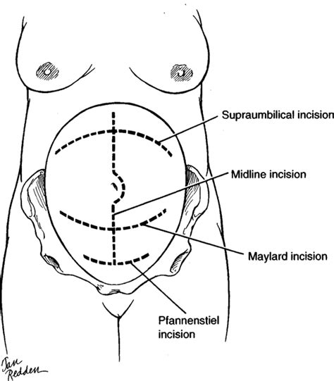 Anatomy, Incisions, and Closures | Obgyn Key