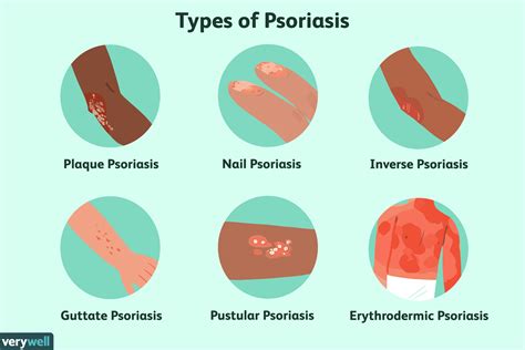 How Psoriasis Is Treated