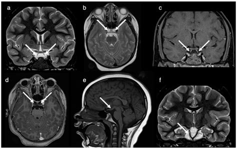 Normal Pituitary Mri