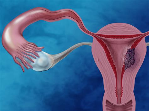 Endometrial Cancer Endometrial cancer - Diseases Club Center 2