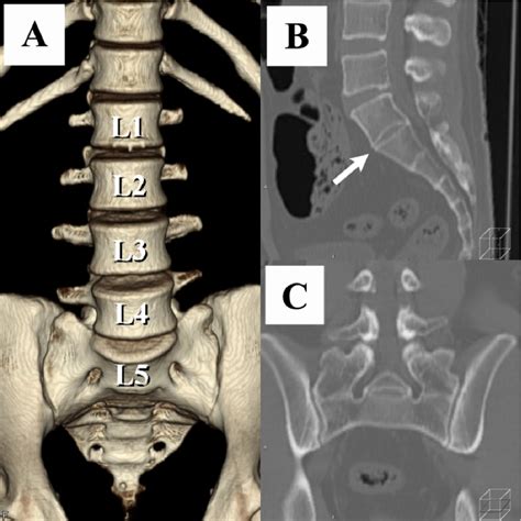 Figure 3 from The association between lumbar rib and lumbosacral ...