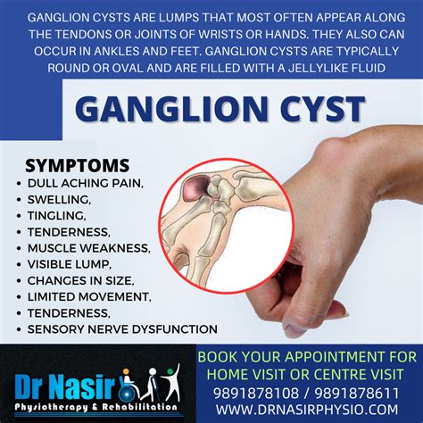 Ganglion Cyst Causes Management Of Painful Ganglion Cysts | NBKomputer