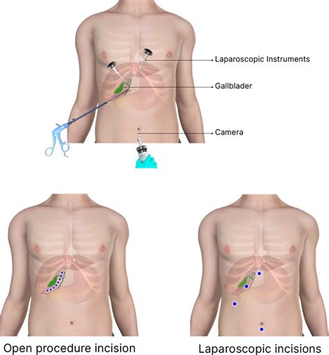 Gallbladder Pain Location Diagram