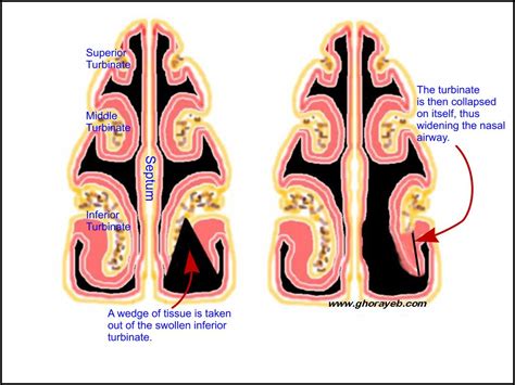 Turbinate Reduction Nasal (turbinectomy) Surgery In Iran | Medpersia ...