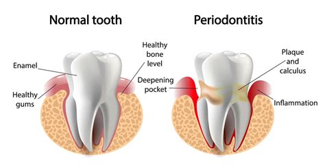 The Stages of Periodontal Disease | Bowmanville Dental