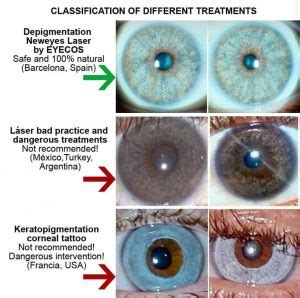 Eye Color Change: Keratopigmentation versus laser depigmentation ...