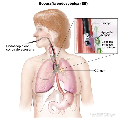 Tratamiento del cáncer de pulmón de células no pequeñas - NCI