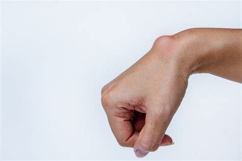 Ganglion -Wrist - Connecticut Orthopaedics