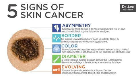 Top 5 Skin Cancer Symptoms & 4 Natural Treatments