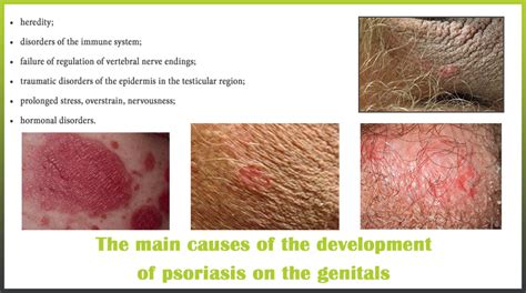 causes psoriasis genitals | Psoriasis expert