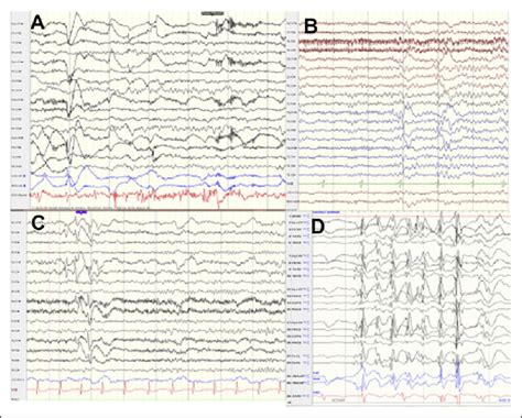 Normal Versus Abnormal Eeg