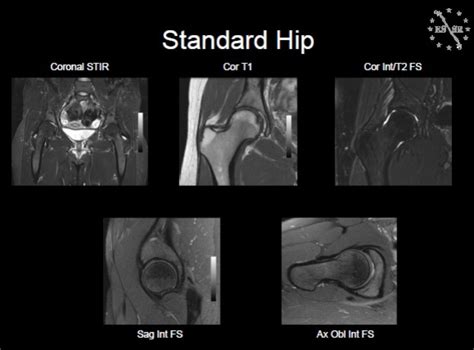 Hip MRI