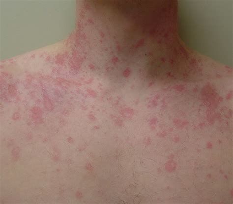 Pityriasis rosea = النخالية الوردية