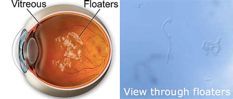 Eye Floaters & Flashes | Eye Doctor Hamden