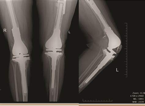 Distal Femoral Fractures: Complications and How to Avoid them? – Trauma ...