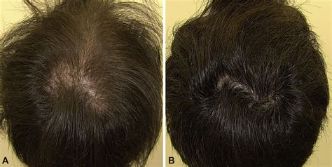 Minoxidil Before And After: Photos & Results | Wimpole Clinic