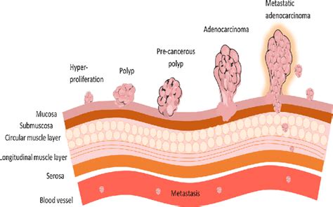 Stages of colorectal cancer. Hyperproliferation of epithelial cells ...