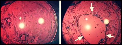 YAG Capsulotomy — NEW WEST EYES