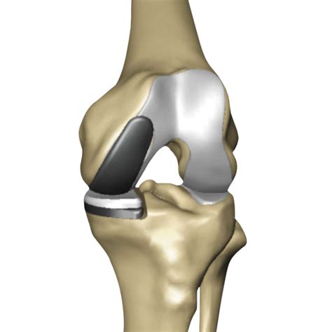 Partial Knee Replacement – Nolan A. Maher, MD