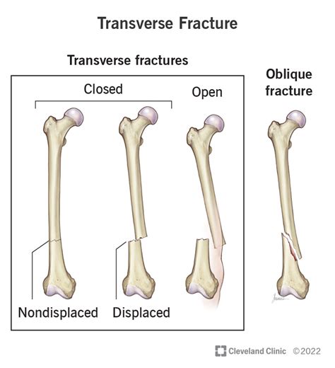 Transverse Fracture: Symptoms, Causes & Treatment