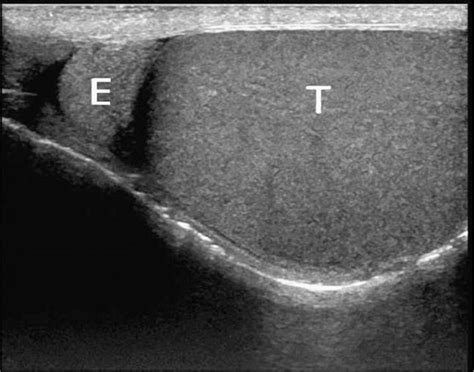 Ultrasound of the Testes or Scrotum - Harmonic Medical Sonography ...