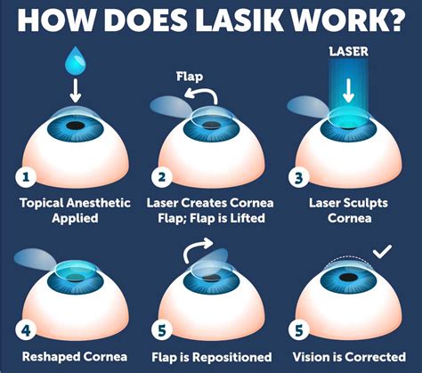 LASIK Surgery & Recovery Process | Wolfe Eye Clinic