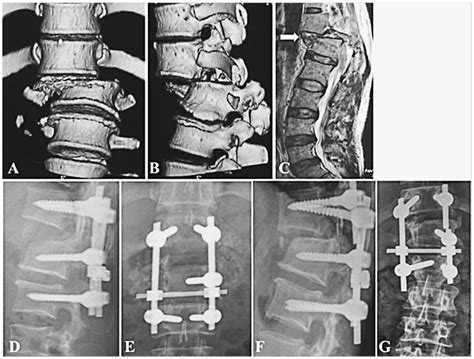 Type C2.2.2 fracture-dislocation in T12-L1 (A, B), the disruption ...