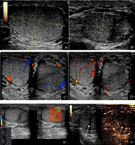 -Scrotal ultrasound findings at three months postoperatively. (A, B) 2D ...