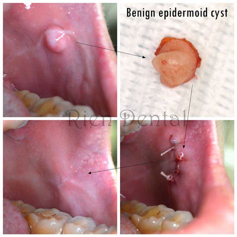 Epidermoid cyst in cheek.