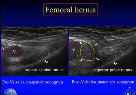 Direct Inguinal Hernia Ultrasound