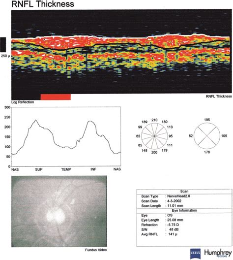 A single OCT scan of a normal eye. | Download Scientific Diagram