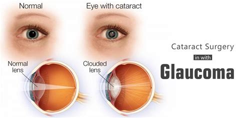 Cataract Surgery in Eyes with Glaucoma-Contoura Vision India