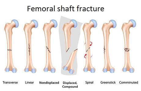 Femur Fracture