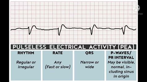 Pulseless Electrical Activity Vs Asystole